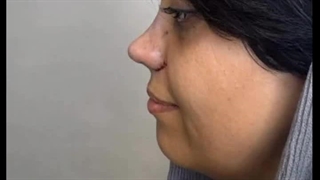 جراحی بینی بدون بیهوشی در کلینیک مسیح