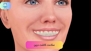 ایمپلنت دندان برای دندان‌های جلویی شکسته | سلامت کاشت درین