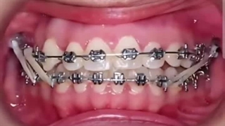 پروسه درمان دندان بیرون تر از قوس فکی