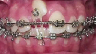 بیرون کشیدن دندان نهفته با ارتودنسی و پروسه اش رو توی این فیلم میبینید