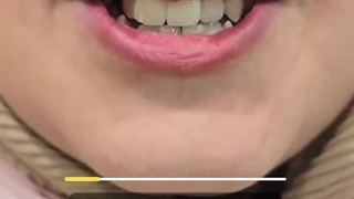 دندان خارج از قوس فکی