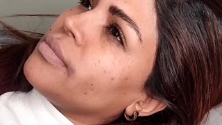 نتیجه‌ای که از نزدیک بهتره! افزایش کنترل‌شده حجم لب در کلینیک آی گل