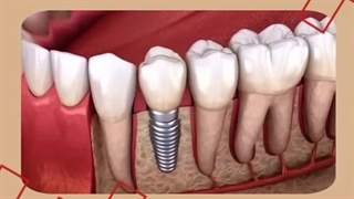 درد و دوره نقاهت ایمپلنت؛ واقعیت علمی چیه؟کاشت ایمپلنت برخلاف تصور عموم، یک جراحی سنگین و دردناک