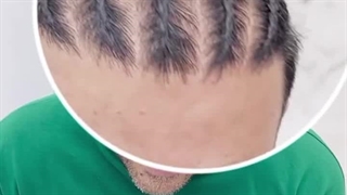 نمونه کاشت مو