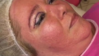 نمونه کار بلفاروپلاستی