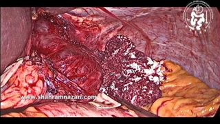 تست متیلن بلو پس از اتمام میوتومی برای آشالازی