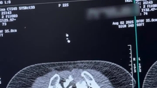 هزینه تزریق سیمان به ستون فقرات