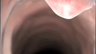 علائم سرطان روده با کولونوسکوپی - کلینیک پایتخت