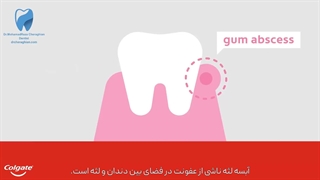 درمان آبسه دندان کودک