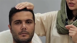 نمونه کار کاشت مو خانم رائی