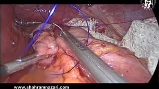 درمان بازگشت اسید معده به مری