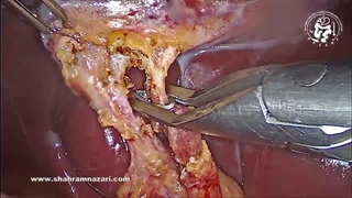 آناتومی زنده از دید جراح با کلانژیوگرامو نمودار مجرای صفراوی متفاوت است