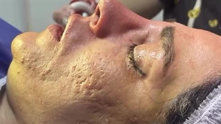 نمونه کار تیپ پلاستی نوک بینی در کلینیک مسیح