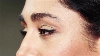 ترند بینی قوزدار