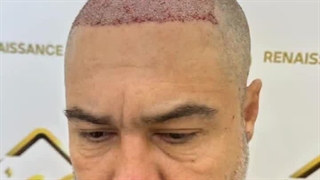 با کاشت مو جذابیتت رو دوباره بساز