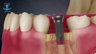 کاشت ایمپلنت - بازگرداندن کامل عملکرد دندان از دست رفته | سلامت کاشت درین