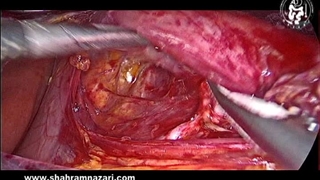 پیش به سوی یک سانتیمتر بیشتر: نقش رهایی چسبندگی واگ-مری برای طول اضافی مری