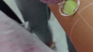 لیزر موهای زائد با تمرکز بر ایمنی و اثر واقعی در کلینیک آی‌گل