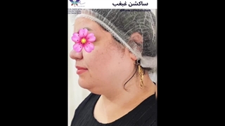 نمونه‌ای از رفع غبغب (4)