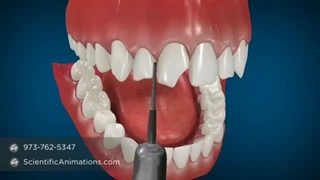 چهره بعد از کامپوزیت چقدر تغییر می‌کند؟