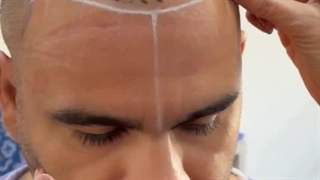 کاشت موی طبیعی بدون جراحی