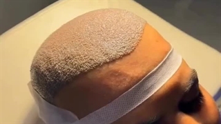 کاشت مو کلینیک حمیداوی