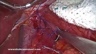 تیپ 2 فتق مری