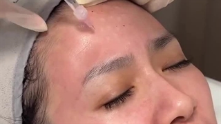 فیلم مزوتراپی صورت - مجله زیبایی بیوتی لند