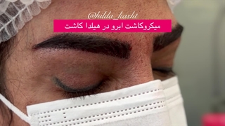میکروکاشت ابرو