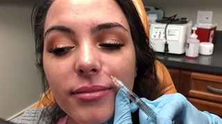 آشنایی با تزریق ژل دنبی؛ تکنیکی کارآمد برای رفع خطوط صورت و افزایش حجم لب‌ها