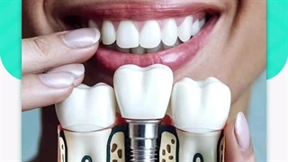 منظور از شکسته شدن ایمپلنت چیست؟ چه طوری از شکسته شدن ایمپلنت جلوگیری کنیم؟