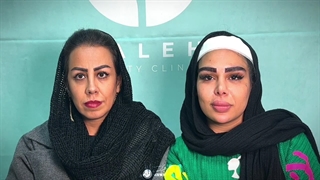 کاشت ابرو در تهران | نتیجه کاشت ابرو بعد یکسال