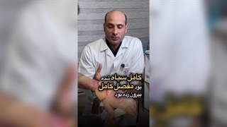 درمان زخم الکتریکی درگیر شده تاندون در کلینیک زخم بهبودان