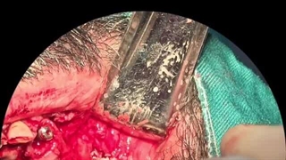 جراحی دندان با بیهوشی کامل در تهران توسط دکتر پورصادقی