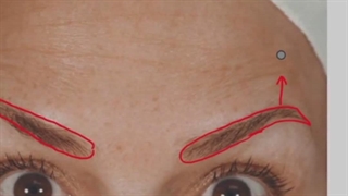 بوتاکس پیشانی _ بوتاکس صورت _ تزریق بوتاکس