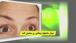 بوتاکس خط اخم _ بوتاکس پیشانی _ بوتاکس صورت _ آموزش بوتاکس