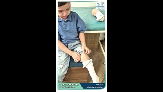 ساخت پروتز مخصوص قطع عضو سایم برای کودک عزیزمون
